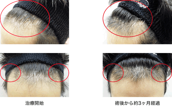 AGA_症状の画像