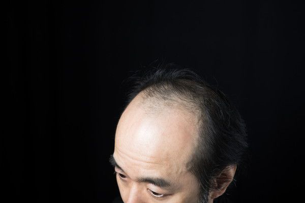 薄毛の画像
